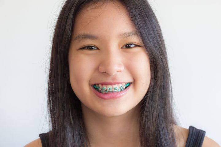Smiling girl with blue-coloured dental braces 