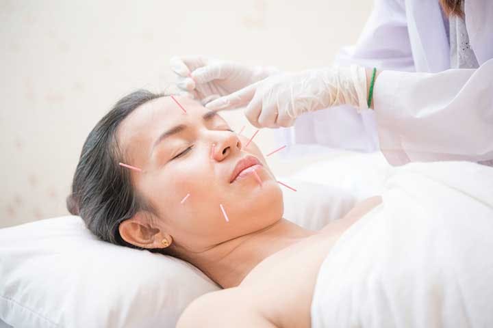 Woman with acupuncture needles in her face lies on a pillow while an acupuncturist places a needle on her temple.