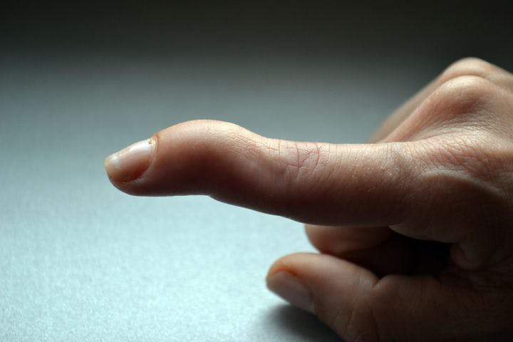 Close-up of a mallet finger extended out while other fingers are folded into a fist, against grey background.