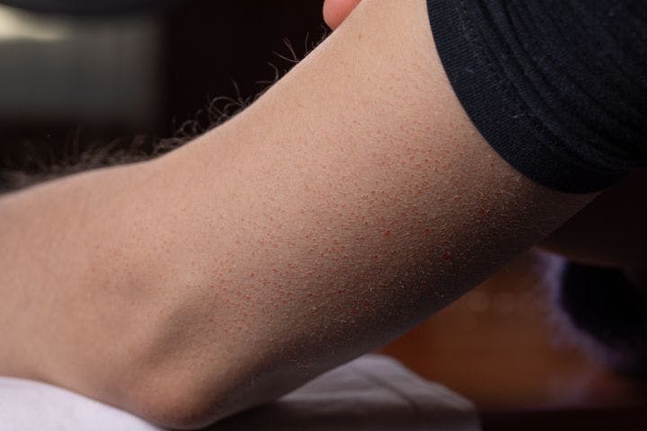 Female arm showing signs of keratosis pilaris in the form of reddish spots