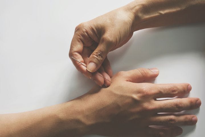 Acupuncturist hand places a needle on the palm of a patient.