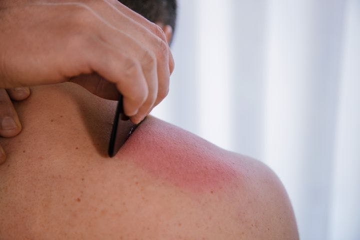 Therapist doing gua sha scraping on bare back/shoulder for pain relief and activating blood circulation