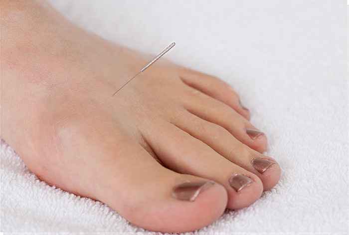 An acupuncture needle placed on the Tai Chong (LR3) acupressure pointon someone’s foot