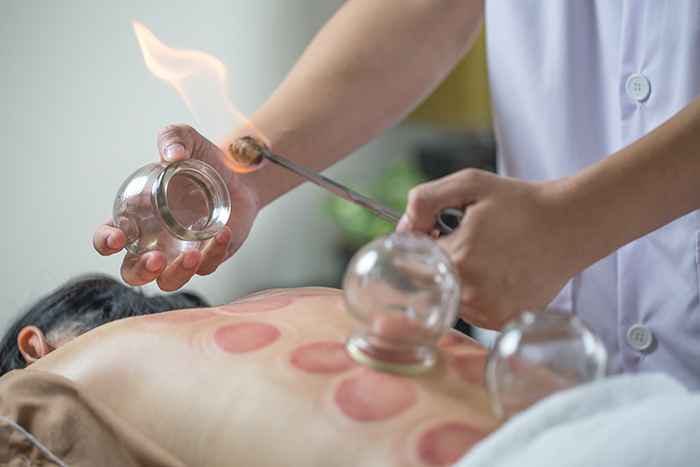 A therapist lighting up a cup before placing it on a patient’s back