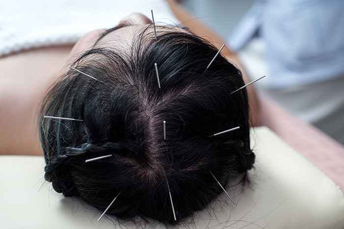 Man with acupuncture needles inserted into his scalp