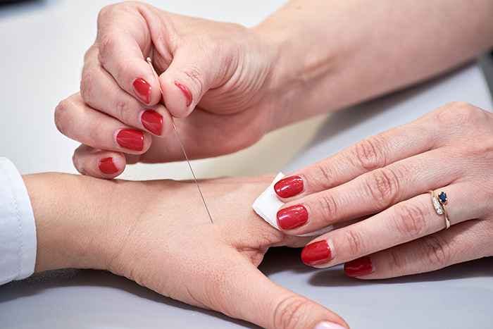 Acupuncturist placing a needle in the (LI4) point on the patient’s hand