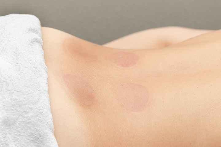 Cup marks on the lower back after cupping therapy