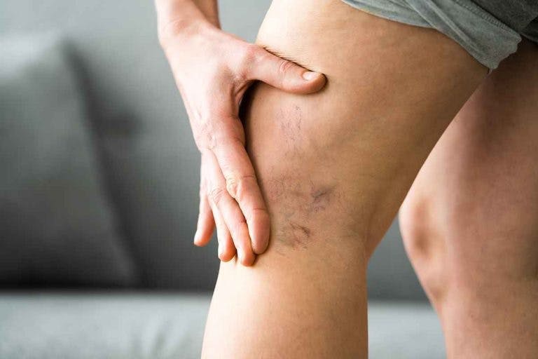 Varicose veins showing on a woman’s left thigh