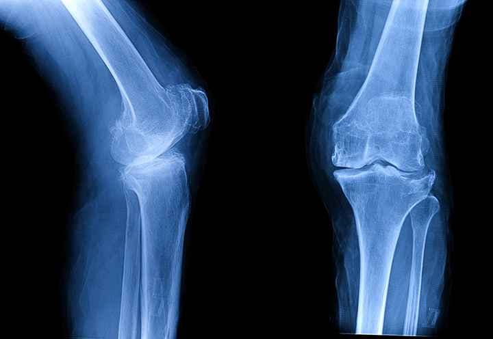 X-ray image of osteoarthritis in the knee.