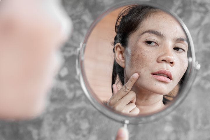Woman with melasma examines her face in the mirror