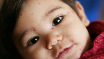 A close-up shot of a toddler with red chickenpox rash on his face