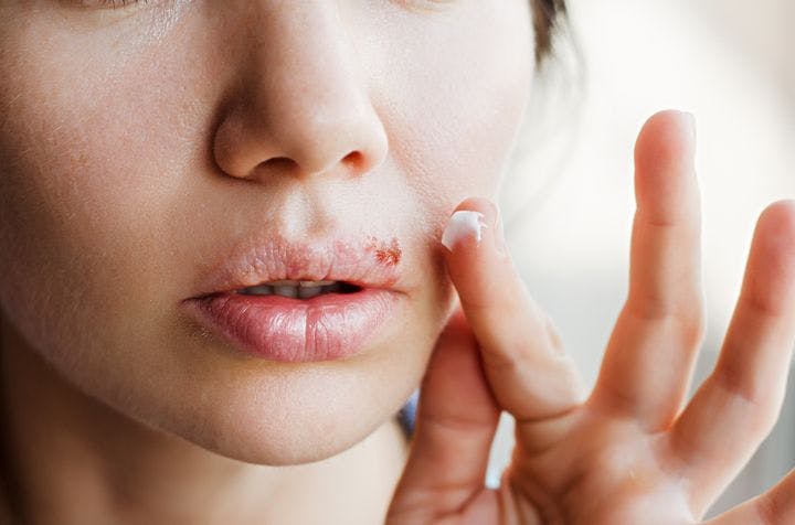 Closeup of woman putting ointment on a cold sore on her upper lip