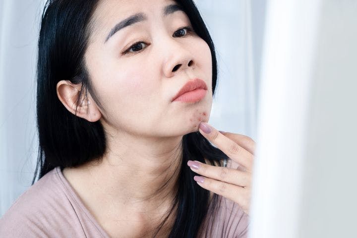 Woman touches her chin with hormonal acne lesions.