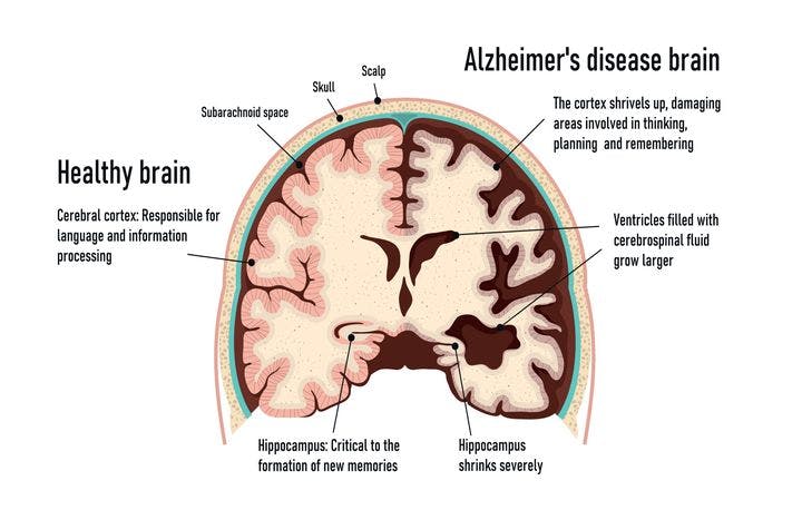 Illustration showing a healthy brain versus a brain affected by Alzheimer’s disease