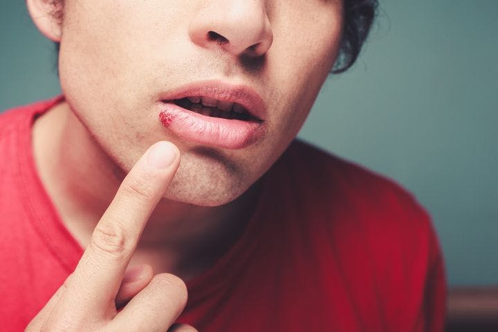 A tell-tale sign of a cold sore is blisters on the lips