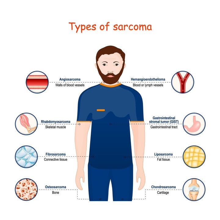 type of sarcoma