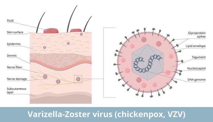 Detailed schematic of the varicella zoster virus and its location in the nerve fibre underneath the skin.