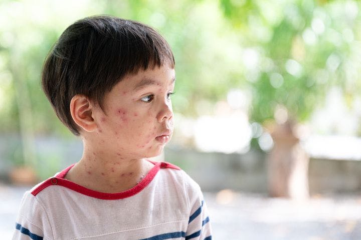 Little boy with varicella zoster or chickenpox rashes all over face and neck