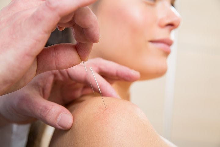 Closeup of hands applying fine needles to a woman’s shoulder