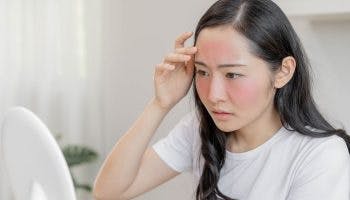 Girl examining her face with acne rosacea in the mirror, looking worried