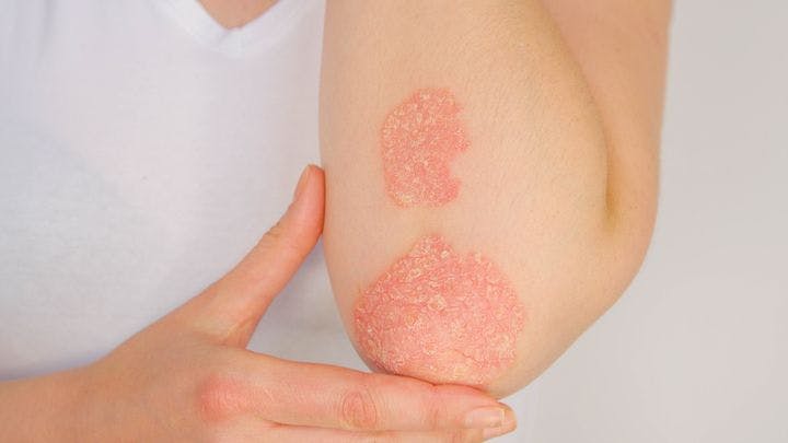 Psoriasis patches on a woman’s left elbow