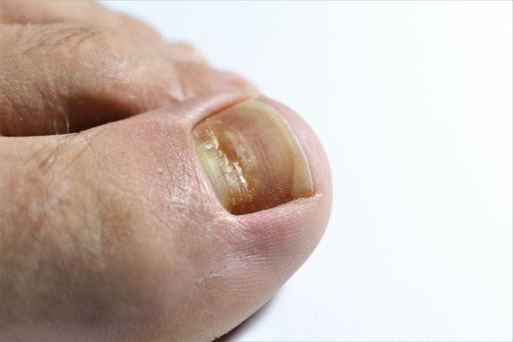 Close-up of horizontal grooves across a person’s left discoloured toenail
