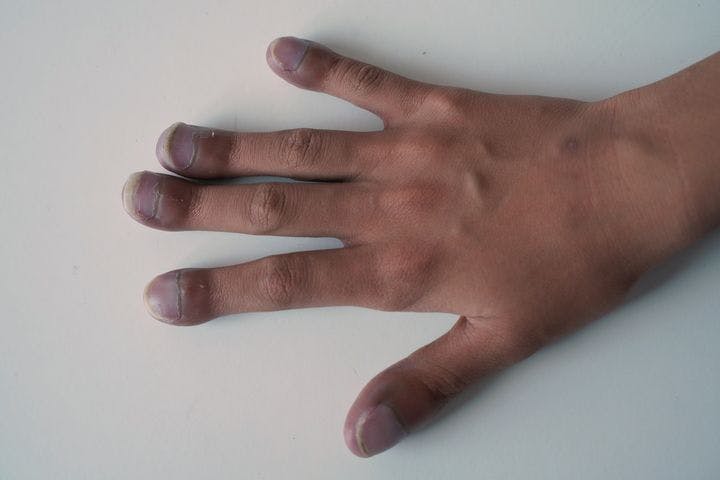 Close-up of a person’s right hand with clubbed fingers