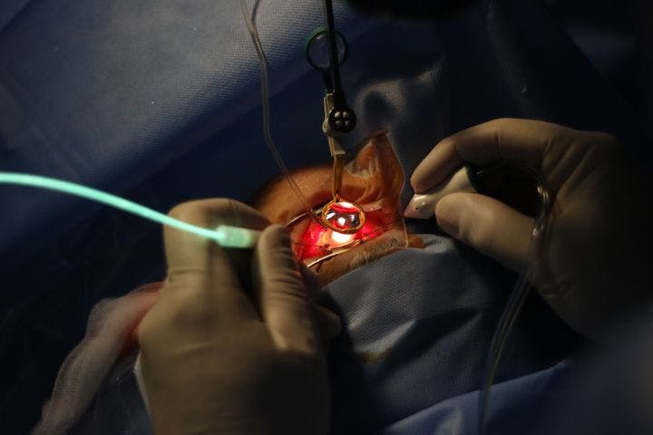 Healthcare provider performing a vitrectomy procedure on a person’s eye