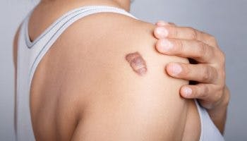 Side-view of a woman's upper body with her left hand placed near a keloid scar on the right shoulder.