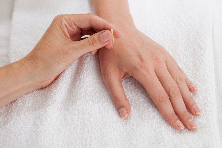 Close-up of acupuncturist hand applying acupuncture needle on he gu acupoint on patient’s hand, against a white towel.