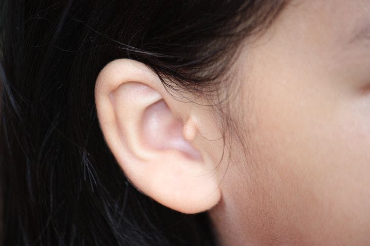 Close-up of a preauricular skin tag on a girl’s right ear