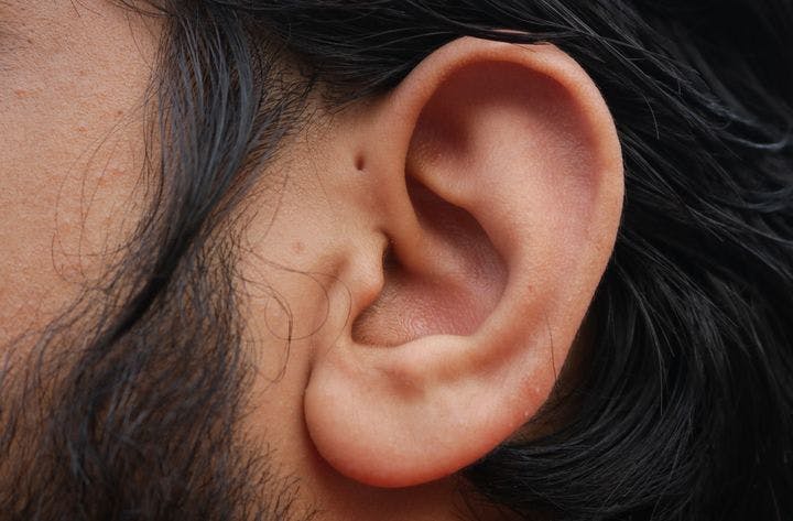Close-up of an ear pit on the front of a man’s ear.