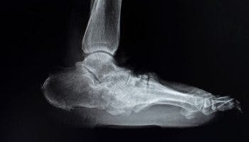 An X-ray scan of a person’s rocker-bottom foot deformity.