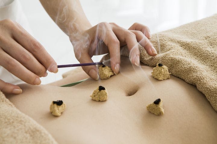Woman lighting up mugwort leaf fluffs that are placed on specific points on another woman’s abdomen.