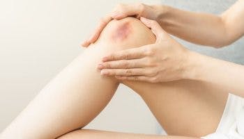 Close-up of a bruise on the inner area of a woman’s right knee.