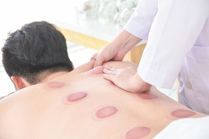 Hands of TCM practitioner performing tuina massage on the upper right shoulder blade of a patient with cupping markings on his back.
