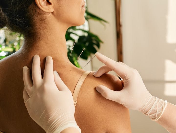 An acupuncturist inserting needle to a woman’s shoulder during an acupuncture session.