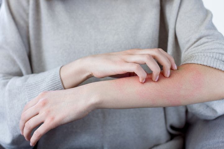 Woman scratching her arm, suffering from a skin condition