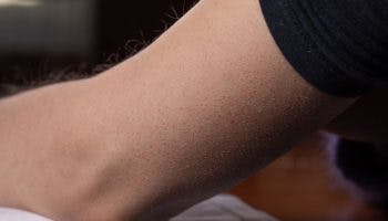 Female arm showing signs of keratosis pilaris in the form of reddish spots