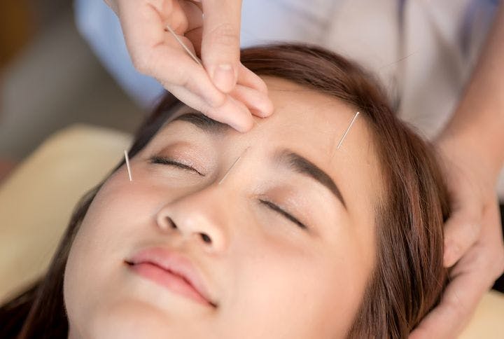 A close-up shot of an Asian woman getting facial acupuncture therapy.