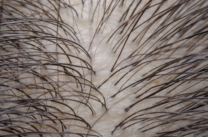 Close-up of a scalp with thinning hair.