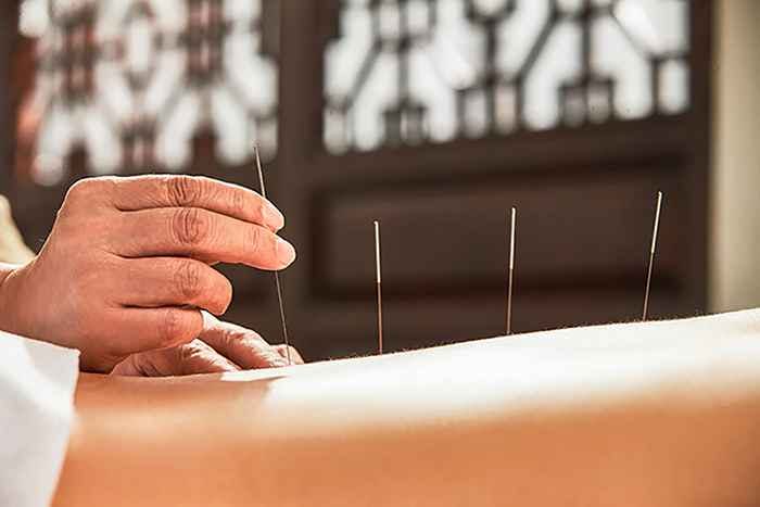 Traditional Chinese Medicine physician places acupuncture needles on a patient’s back.