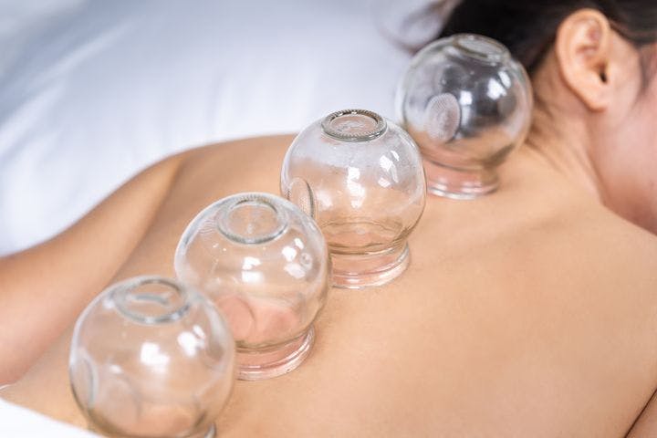 A woman lying on her stomach while undergoing cupping therapy.