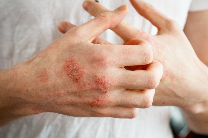 A person scratching their hands, which are red and inflamed from eczema.