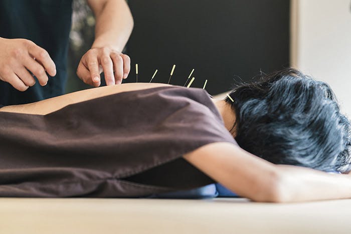 A woman lying face down as she receives acupuncture treatment