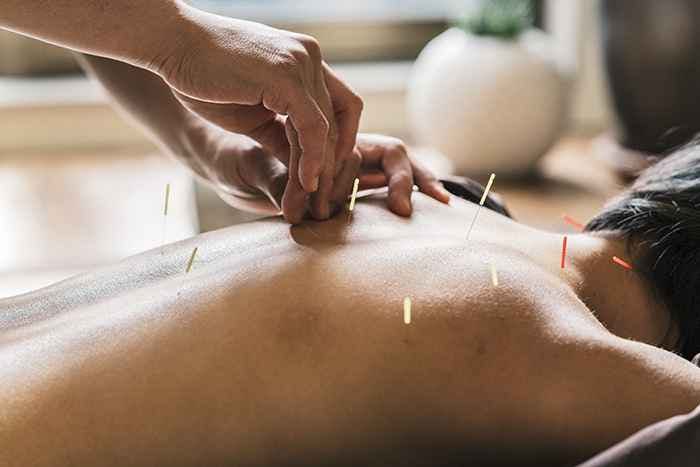 Woman getting acupuncture treatment on her back