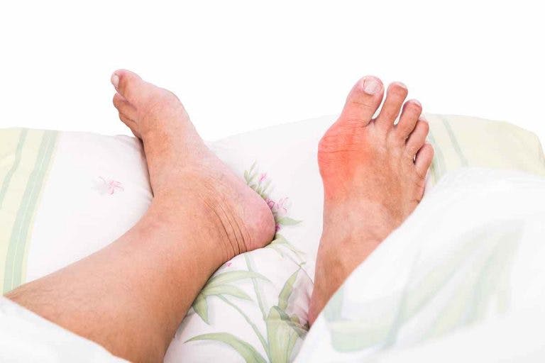 Two feet with swelling and redness of the big toe on the right foot
