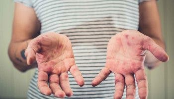 Woman showing tiny, red rash spots that have developed on the palms of her hands