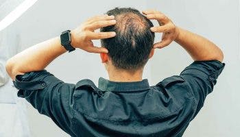 Man holding the sides of his balding head