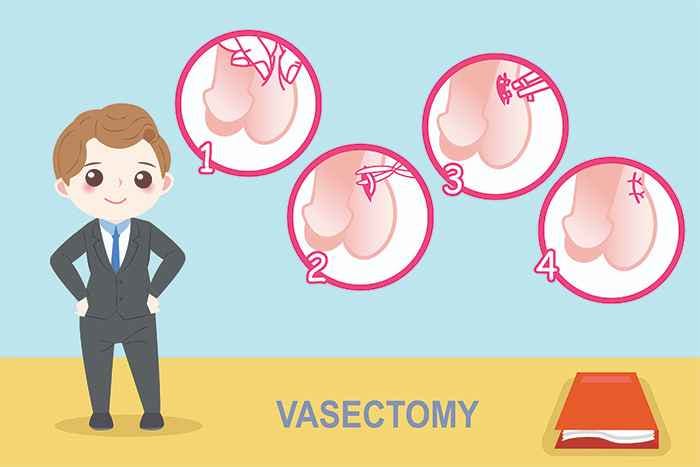 Infographic showing the steps of vasectomy surgery with a man standing